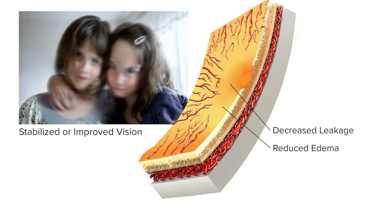 Anti-VEGF Treatment of Diabetic Macular Edema (DME)
