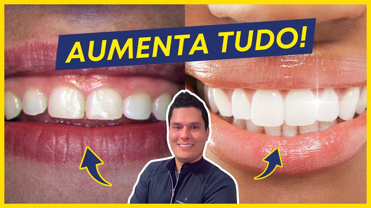 DENTES PEQUENOS: COMO AUMENTAR? (4 SOLU&Ccedil;&Otilde;ES EFICAZES)
