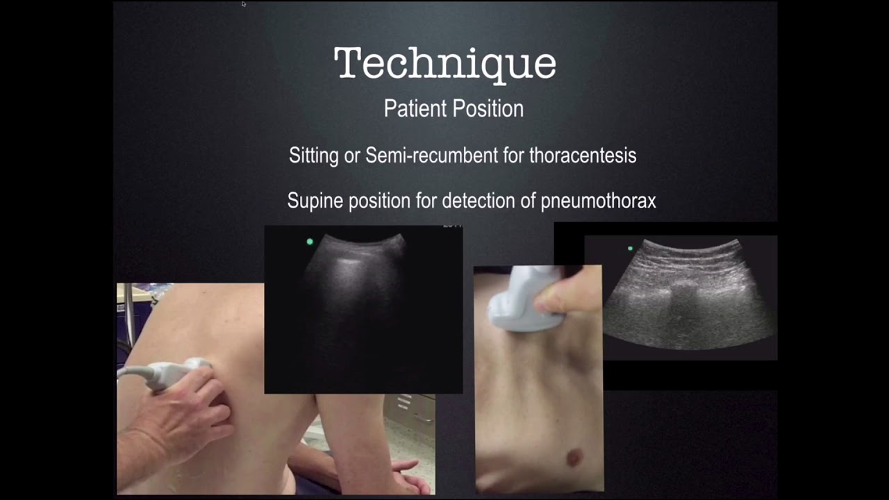 US Guided thoracentesis CUSE 2018