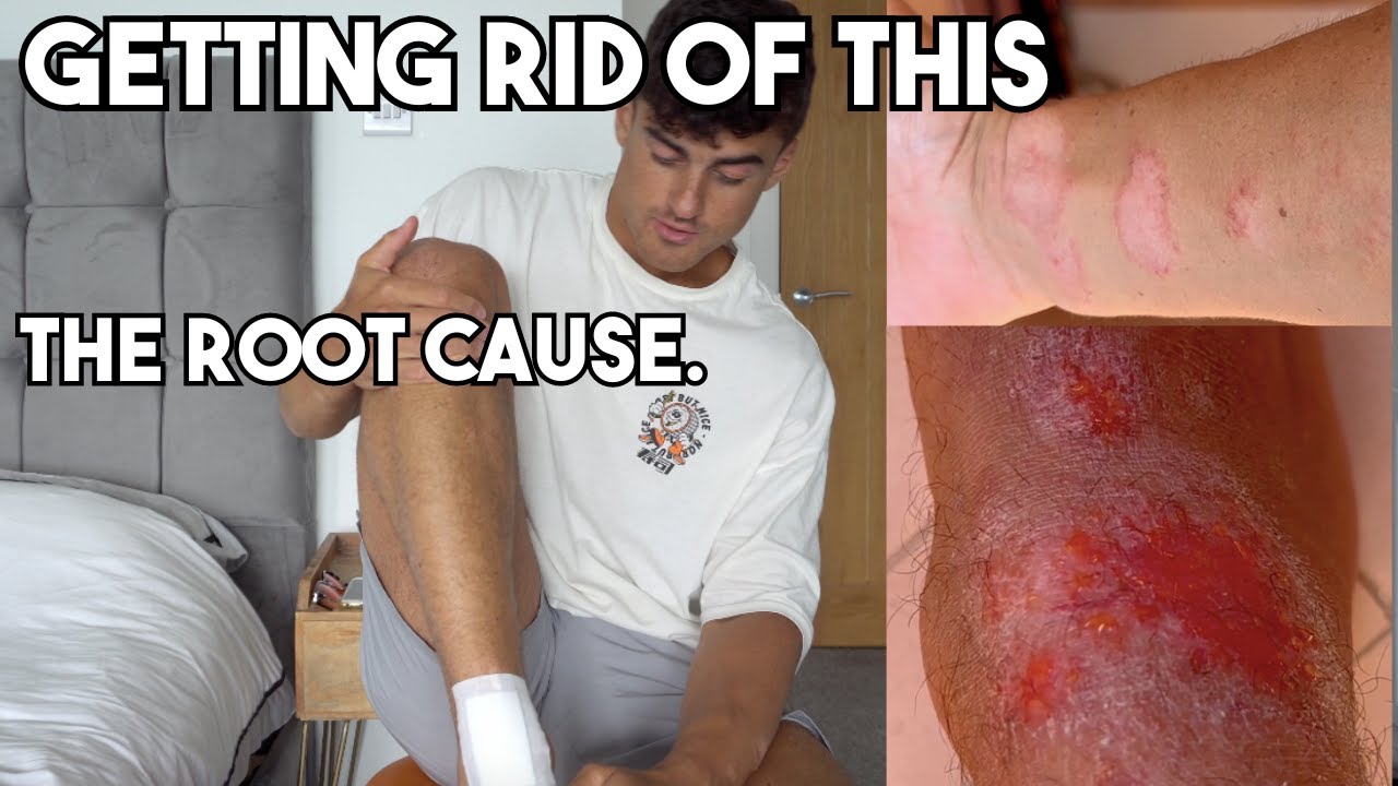 Здоровье кишечника и диета: как вылечить псориаз