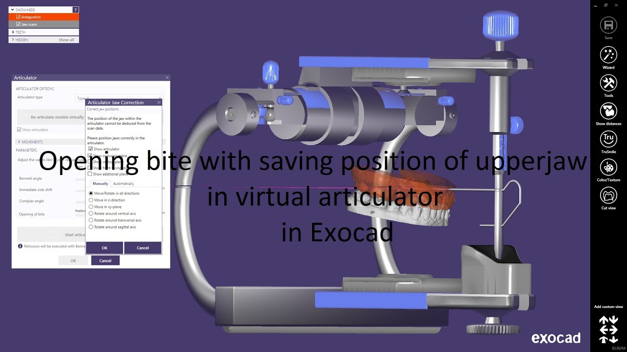 Opening bite with saving position of upperjaw in virtual articulator in Exocad