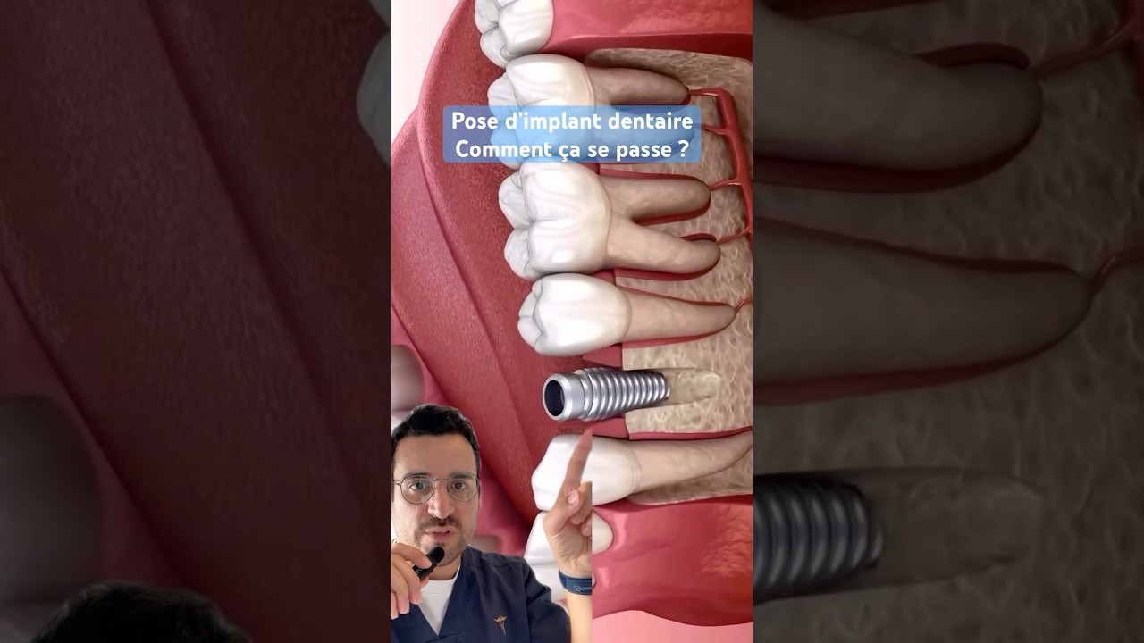 Pose d&rsquo;un IMPLANT DENTAIRE : COMMENT &ccedil;a se passe ?