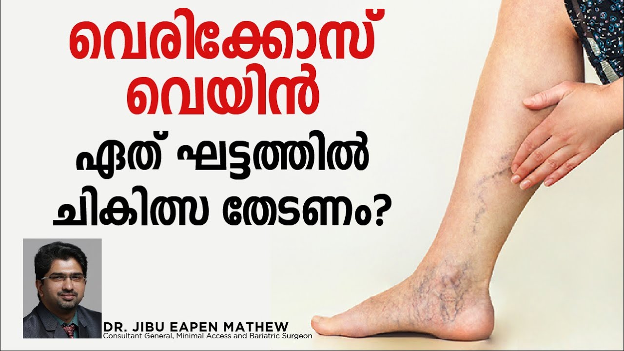 Vericose Vein | Talk by Dr. Jibu Eapen Mathew | Caritas Hospital, Kottayam