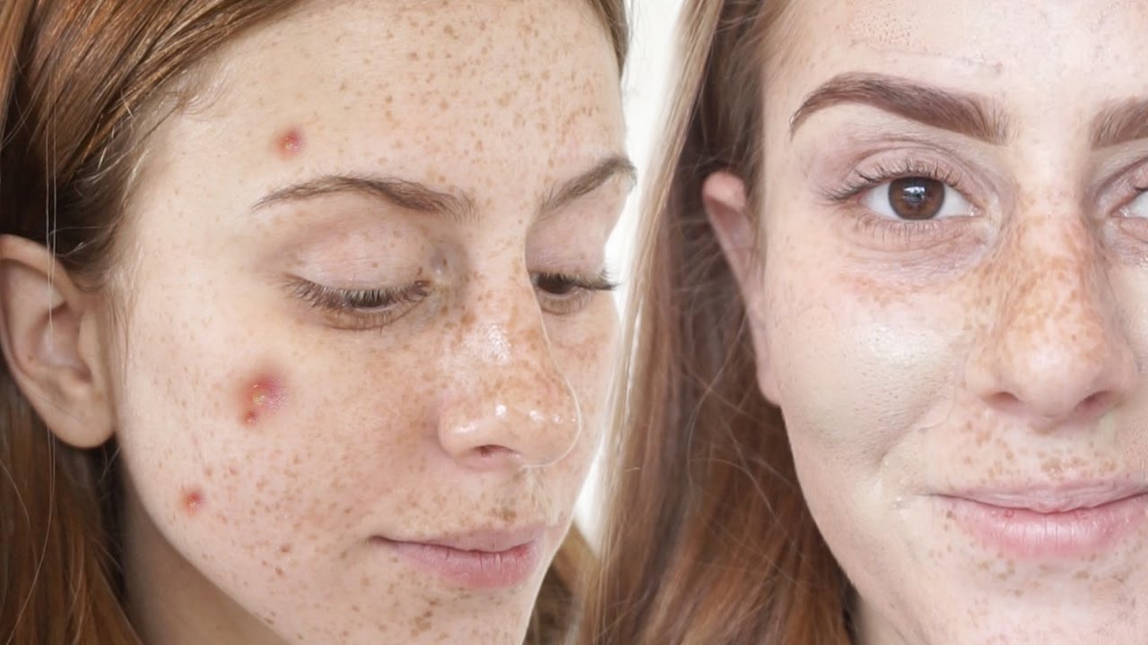 Como Esconder / Acabar com ACNES!!