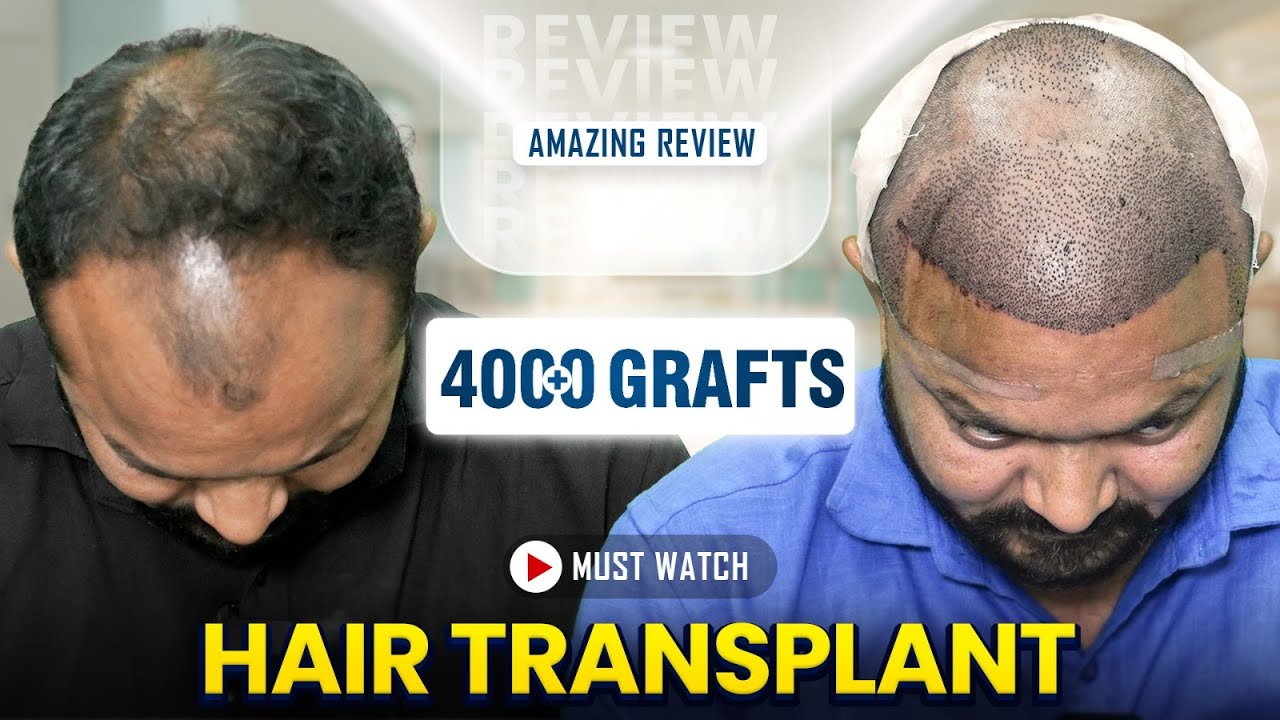Grade 5 Hair Transplant Review| 4200 Grafts FUE | Dr Richa Sanmukhani | Hairfree Hairgrow Ahmedabad
