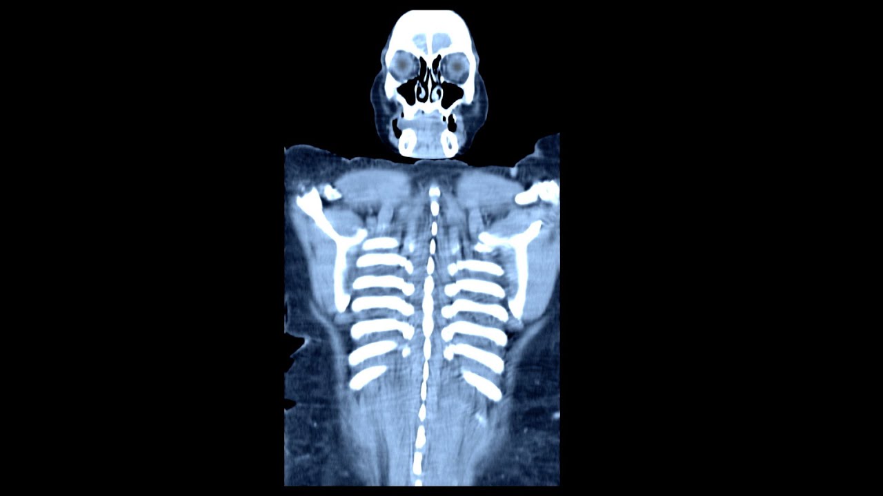 A Woman Ate 23 Bananas After Fasting 7 Days. This Is What Happened To Her Organs.