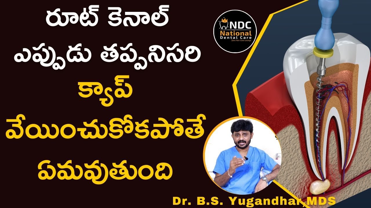 రూట్‌ కెనాల్‌ ఎప్పుడు, ఎందుకు చేస్తారు..? || Step By Step Root Canal Procedure || NDC +91 9169269369