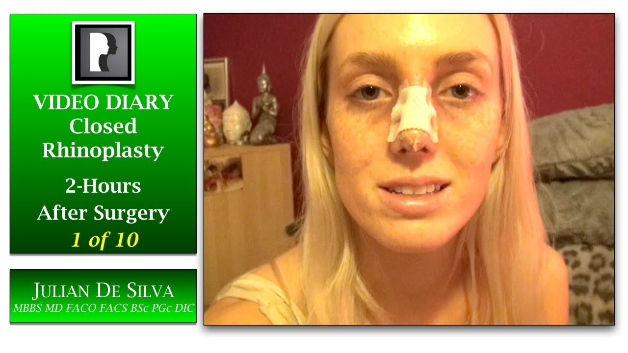 Closed Rhinoplasty Video Diary-  2 Hours After Surgery, 1 of 10