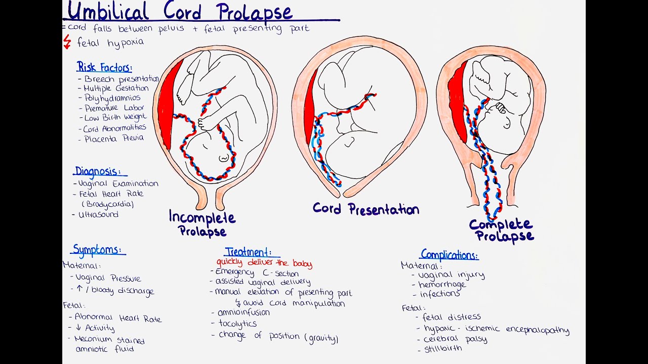 umbilical cord prolapse + cord presentation -  Types, Risk Factors, Diagnosis,  Treatment etc