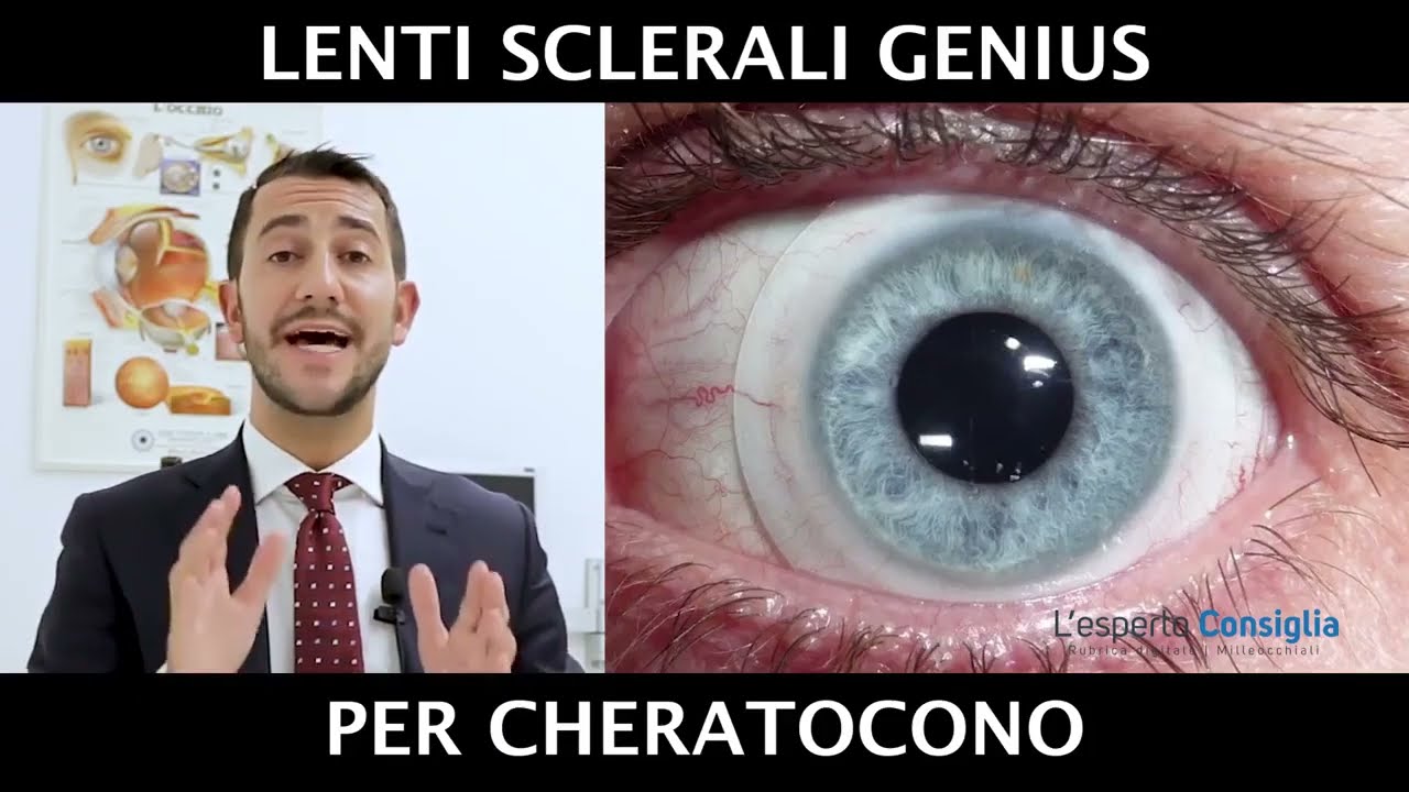 Lenti a Contatto Sclerali per Cheratocono