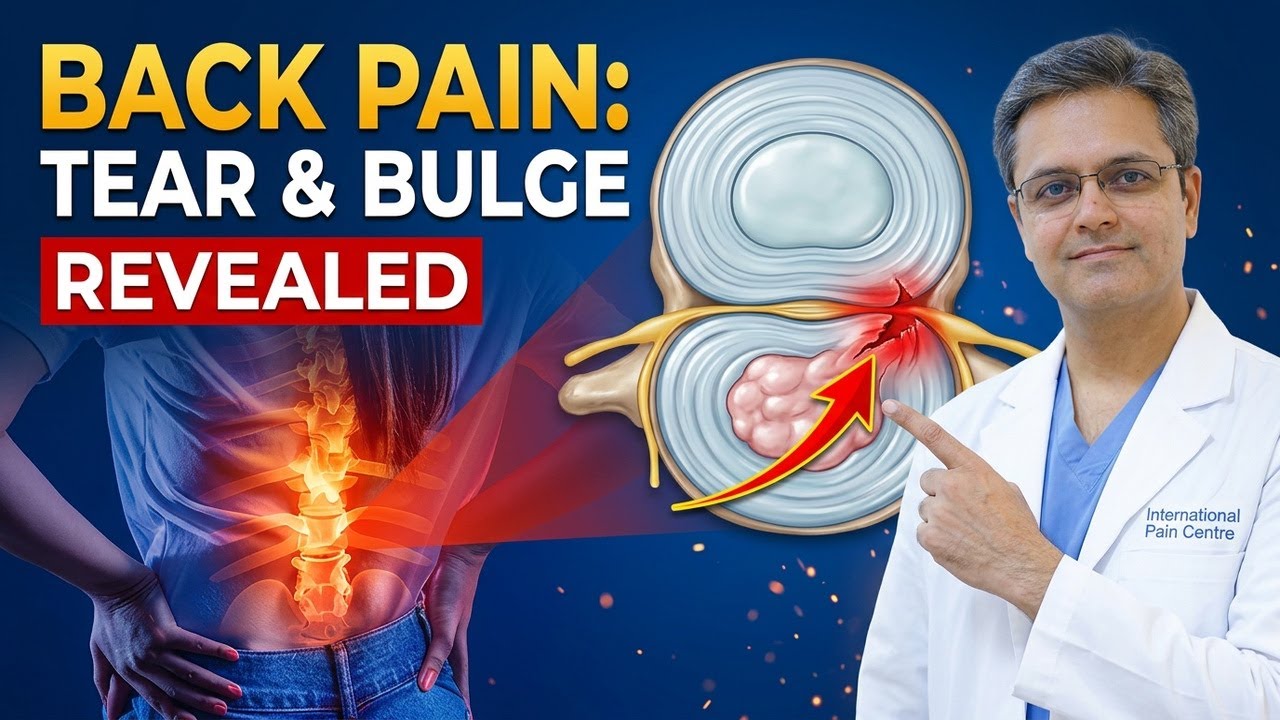 Annular Tear (Disc Tear) Kya Hai? Disc Bulge, Back Pain, Healing & Surgery