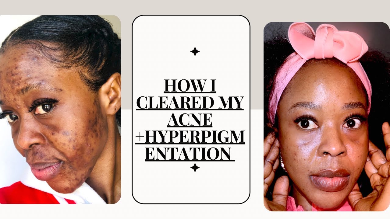 How I Cleared My Acne + Hyperpigmentation