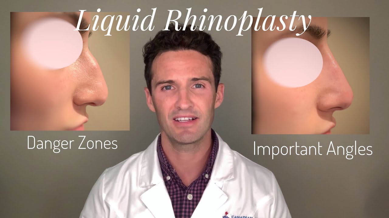 Liquid Rhinoplasty: Everything you need to know!
