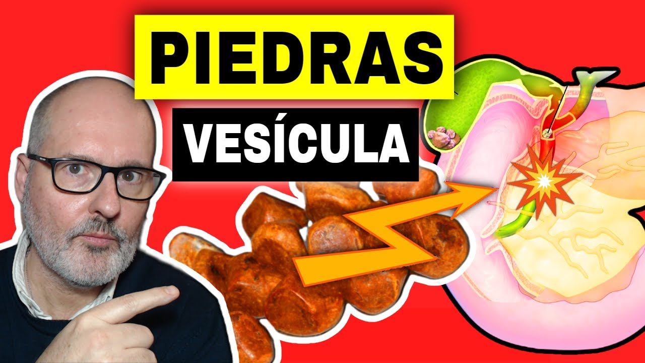 PIEDRAS EN LA VESÍCULA (LITIASIS BILIAR): Por qué se forman, alimentos prohibidos y soluciones