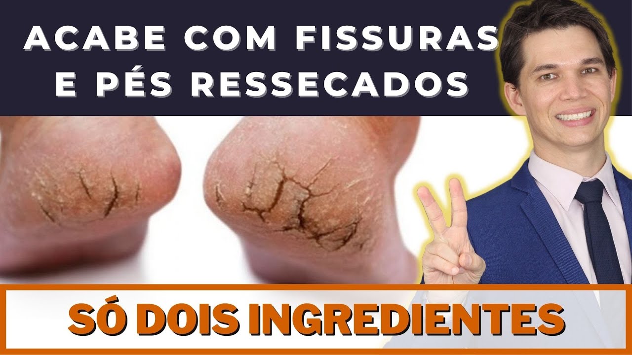 ACABE COM AS RACHADURAS NOS PÉS com apenas 2 Ingredientes e Deixe os Pés Macios