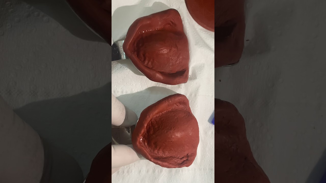 Visit 1: Stock tray selection and its effects on the primary impression