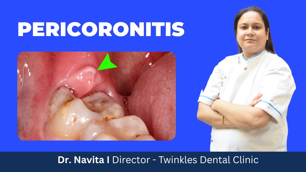 What is Pericoronitis ? How does it occur?, How is it treated? I Home remedies for Pericoronitis I