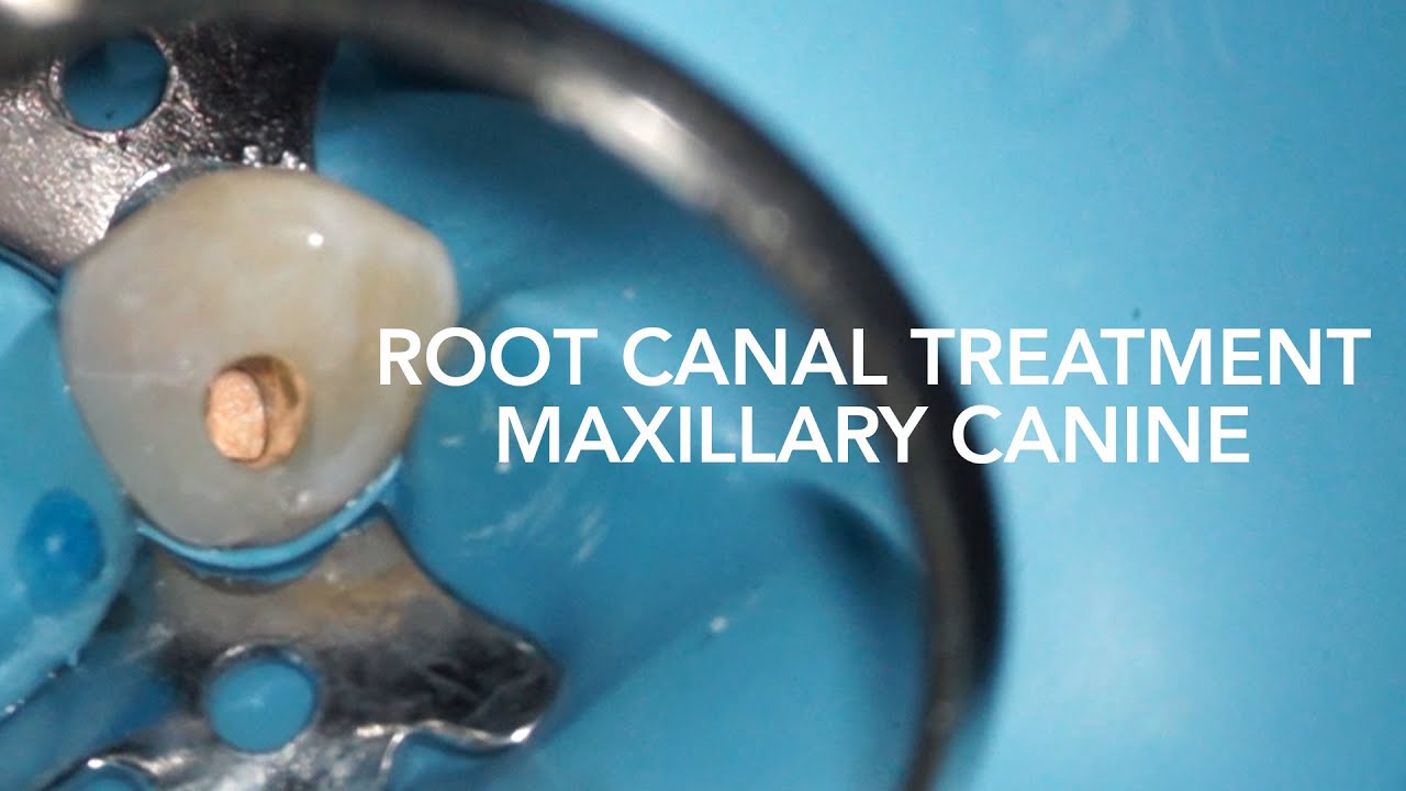 Root Canal Treatment on Maxillary Canine (Tooth 23)