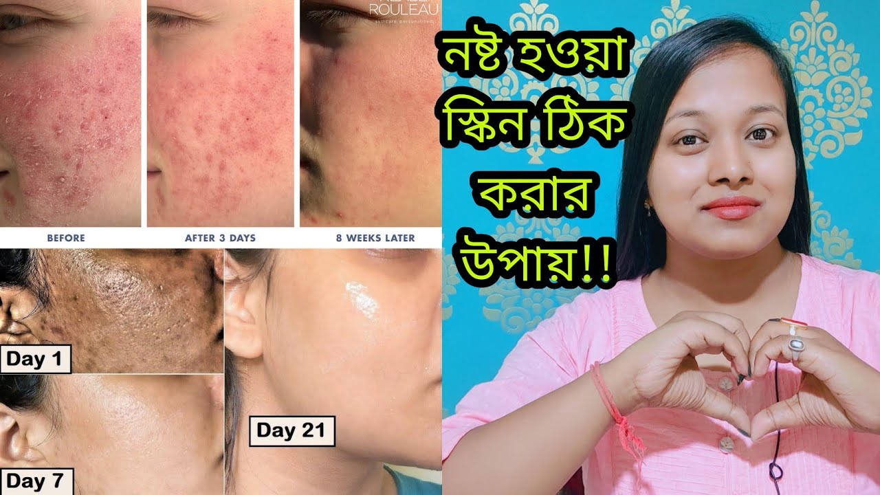 ভুল ভাল ক্রিম মেখে নষ্ট হওয়া ত্বক কে ভালো করো এই উপায়ে|100% working tips to repair damaged skin