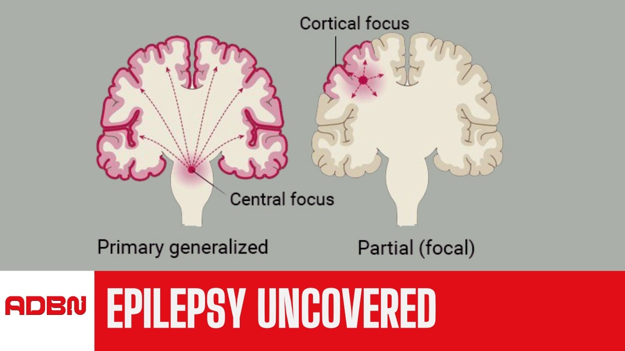 Breaking the Stigma: Epilepsy Uncovered | Softline