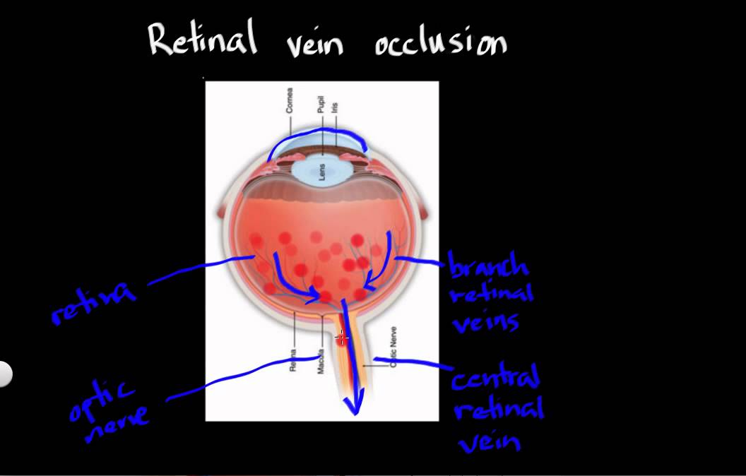 Retinal vein occlusion