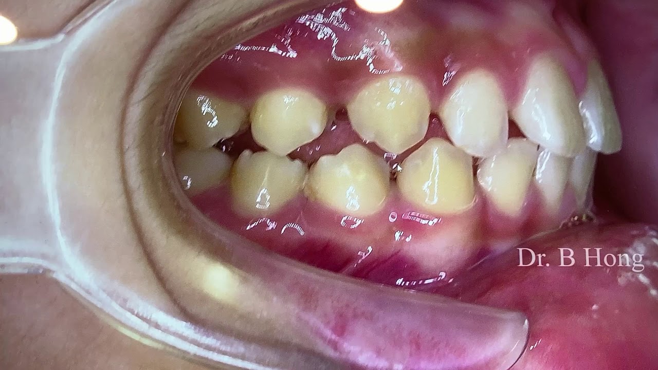 Non-extraction Non-surgical treatment to correct severe overbite