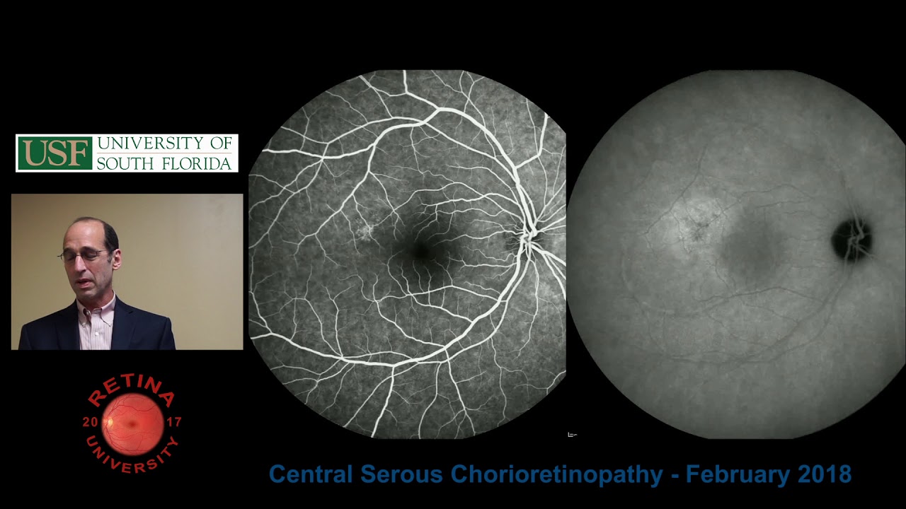 Central Serous Chorioretinopathy