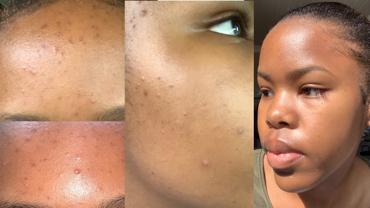 This Dermatologically Approved Routine Cleared My Skin 🥺