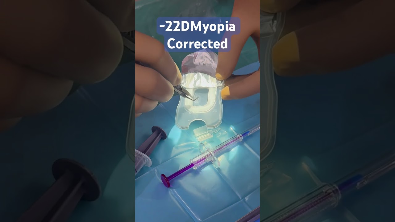 -22D Myopia corrected by IPCL #refractivesurgery #suneyecafe #drsudhirsrivastav