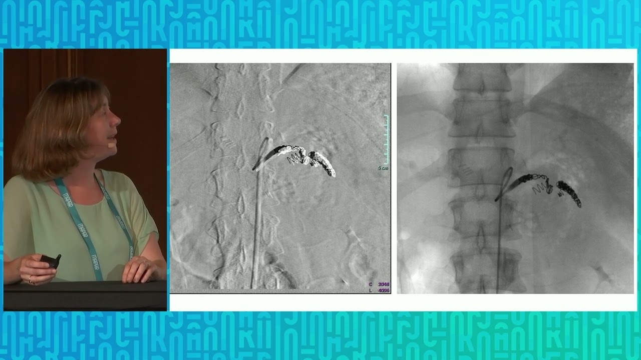 Points sur les fractures de rate