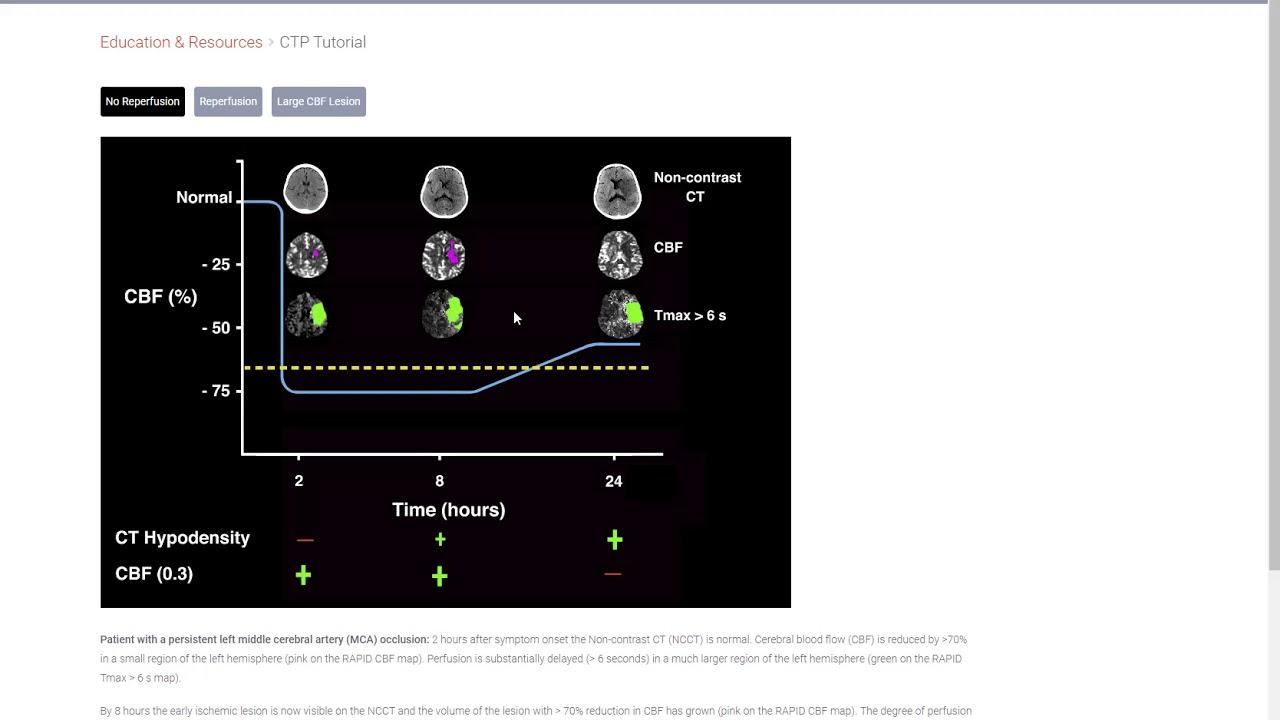 Starting CT perfusion service using ischemaview/Rapid software for a community stroke center