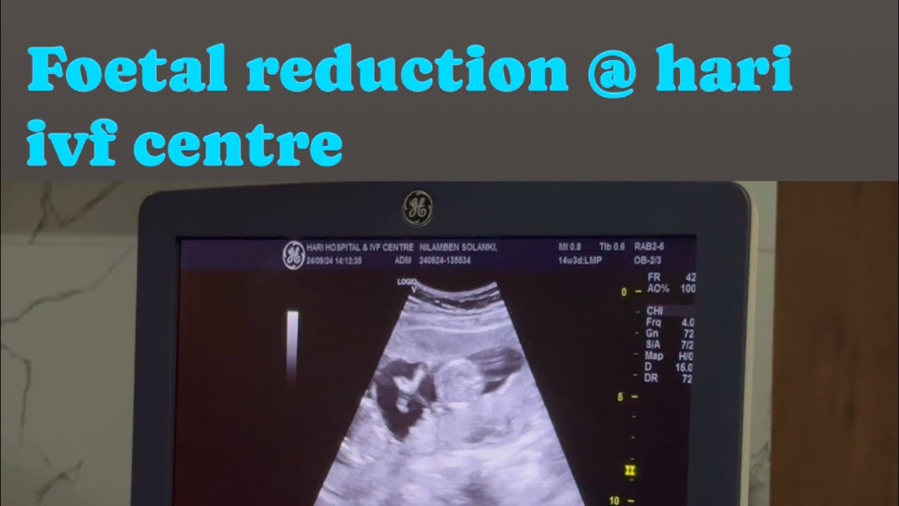 foetal reduction from 3 BABIES TO 1 BABY  @ hari ivf centre 7405395169