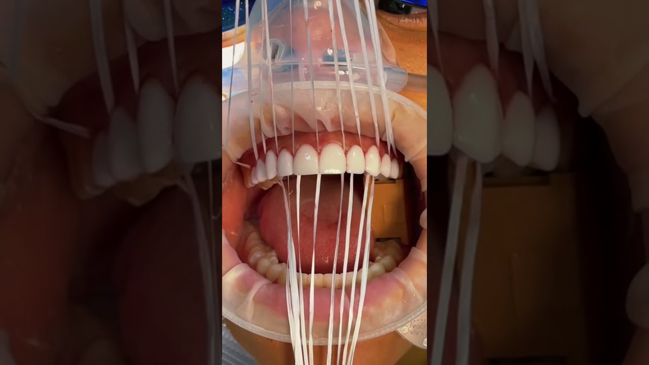 Trust the process! My final porcelain veneers 🦷 #shorts