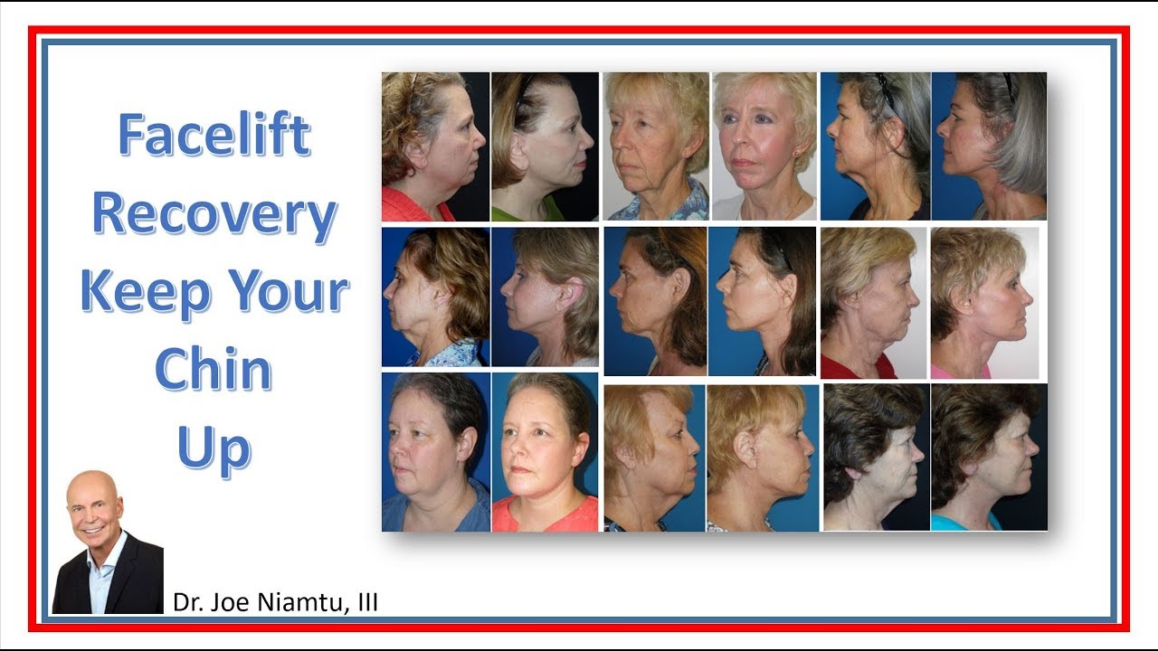 Facelift Recovery: Keep Your Chin Up!