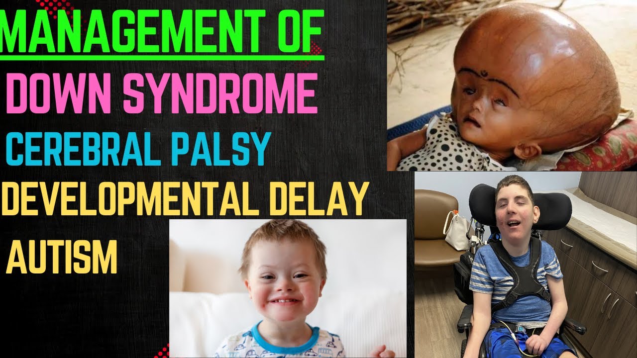 MANAGEMENT OF down syndrome, cerebral palsy, muscular dystrophy, development delay, meningitis.
