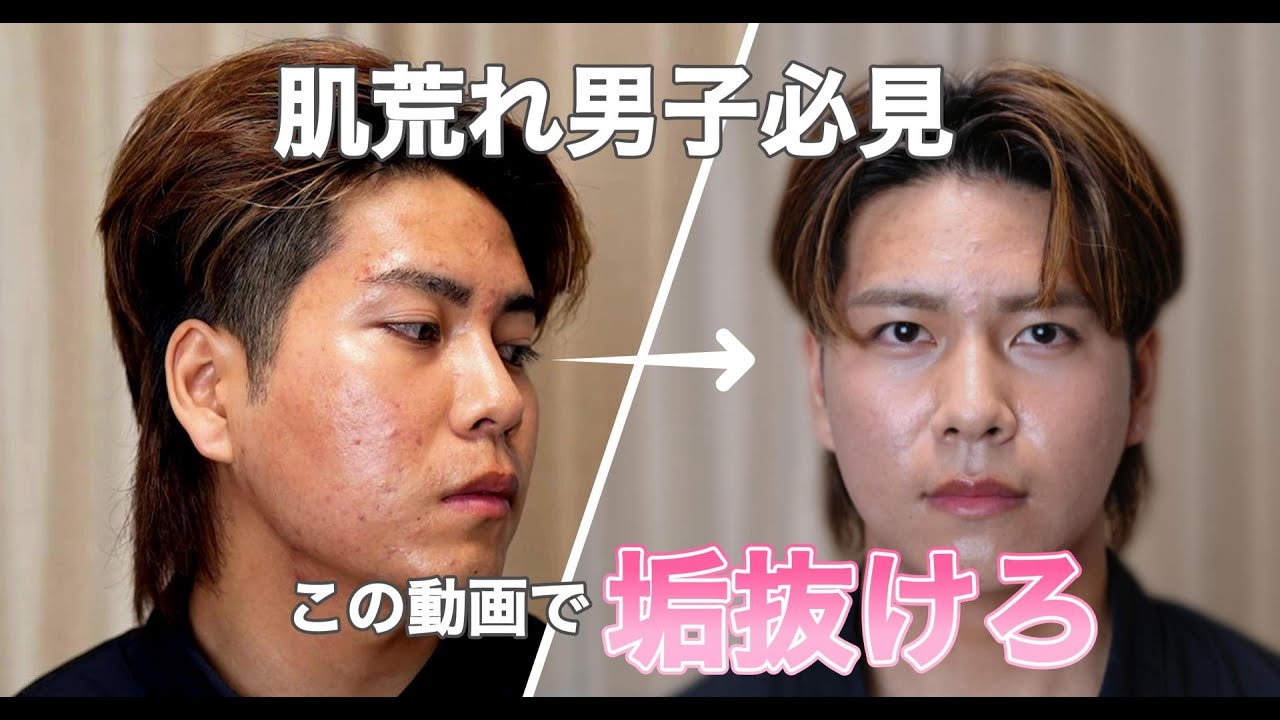 【肌荒れ男子必見】肌荒れしても垢抜けたい人はこれみて！