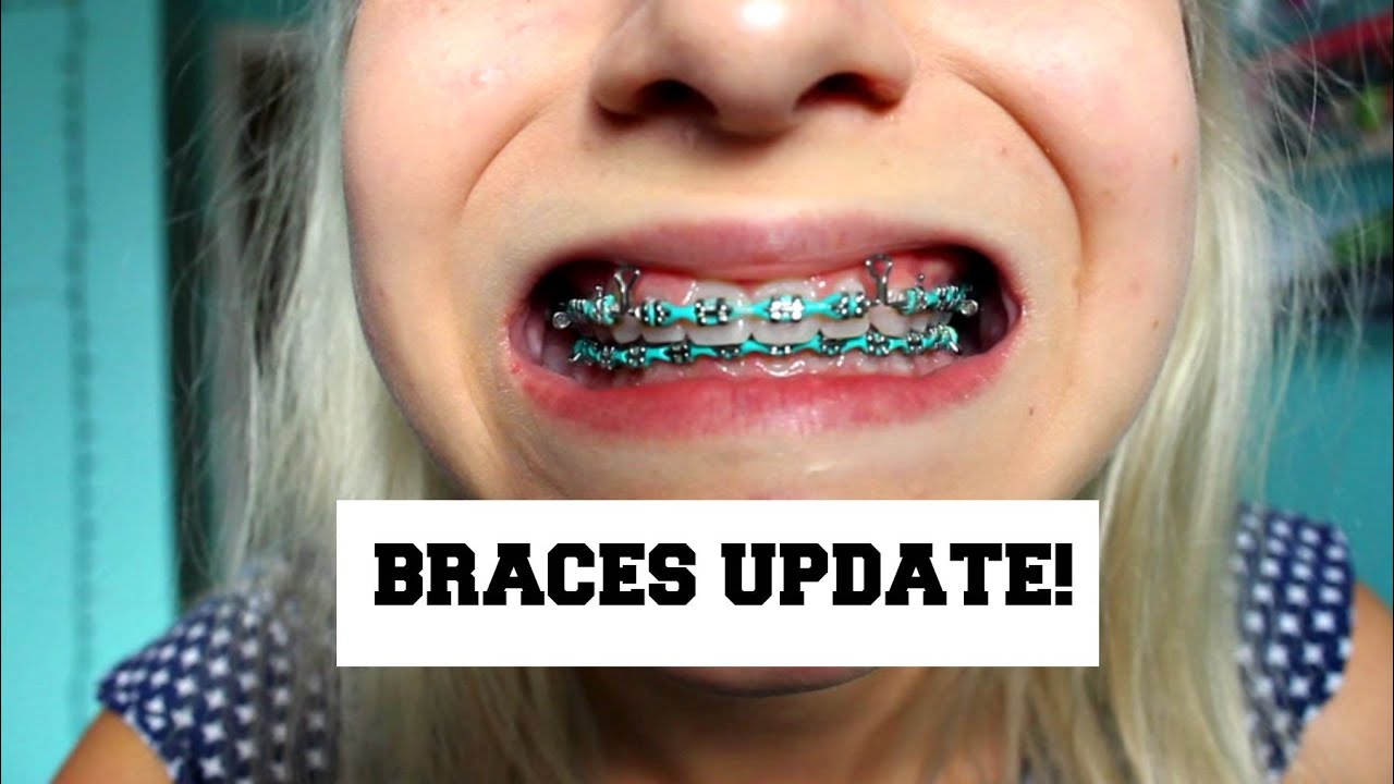 BRACES UPDATE! New wire and brackets|| Lilyslounge14