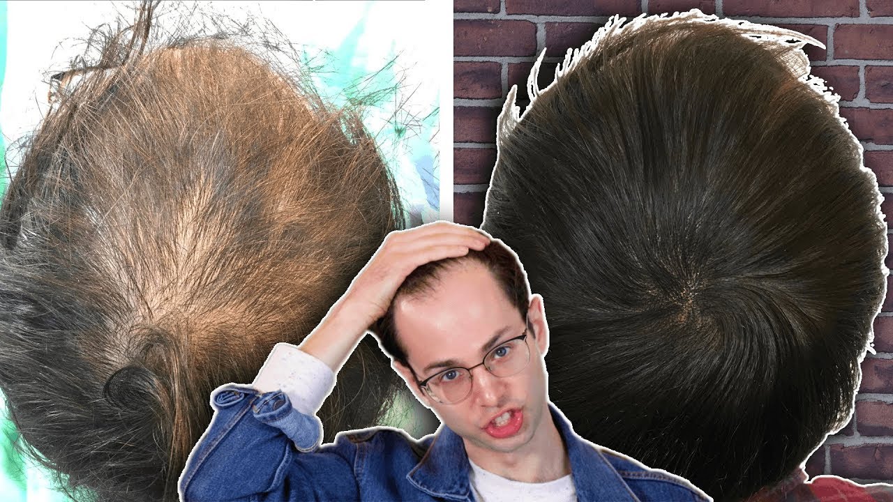Microblading My Scalp For Balding