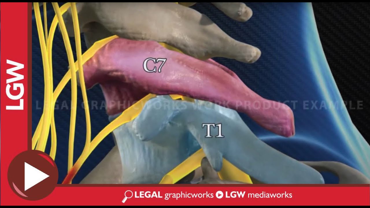 C7-T1 ESI (epidural steroid injection) animated surgery recreation