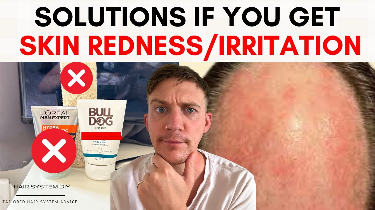 Skin Redness or Scalp Irritation..?