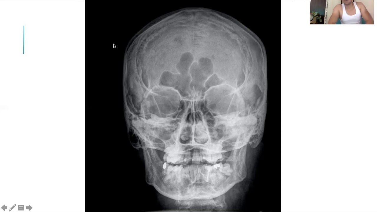 Radiología simple de cráneo