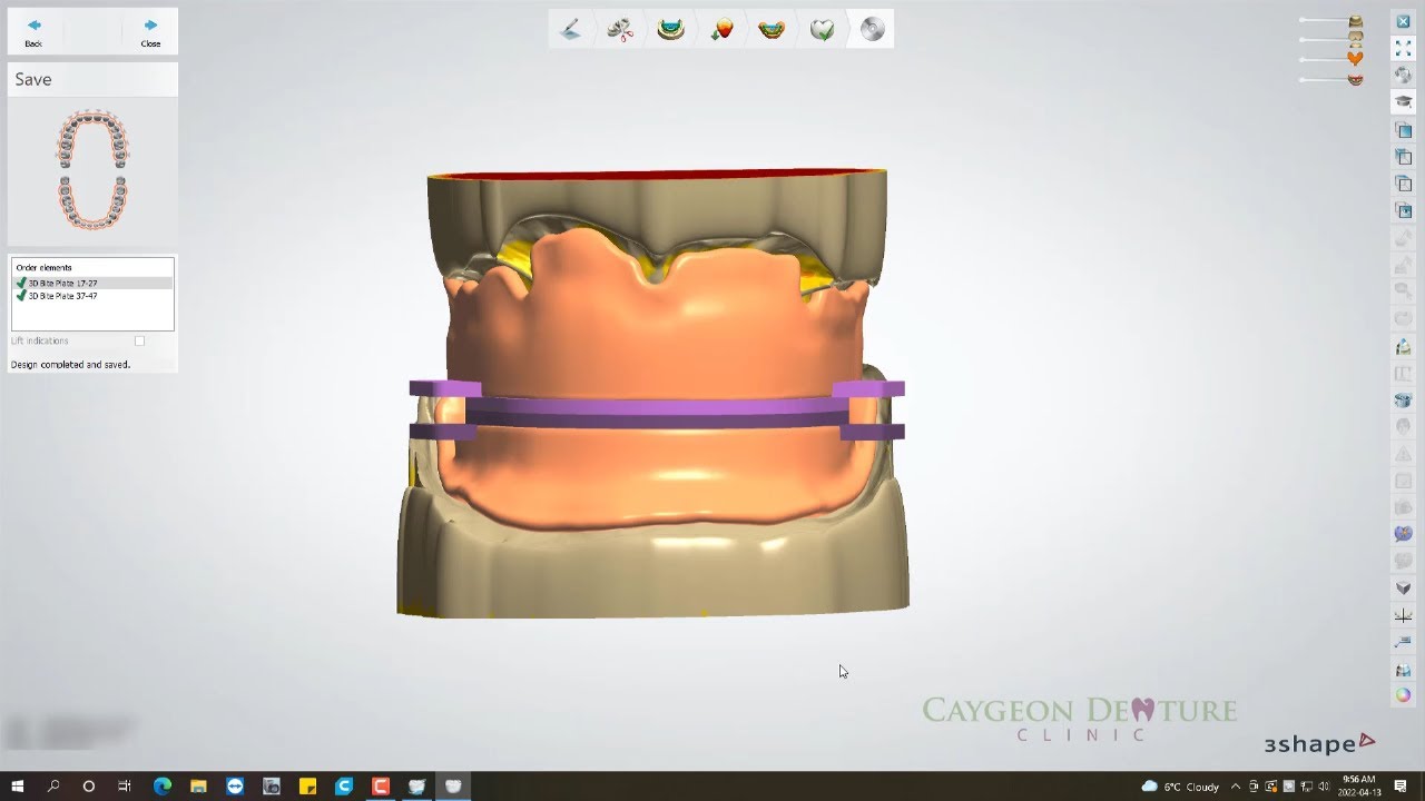 How To Fabricate A 3D Bite Plate From Digital Scans