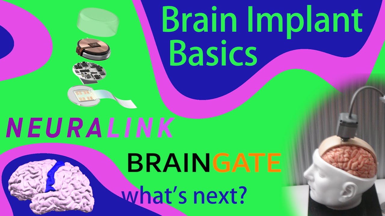 Что можно делать с мозговым имплантом? Neuralink, BrainGate и будущее