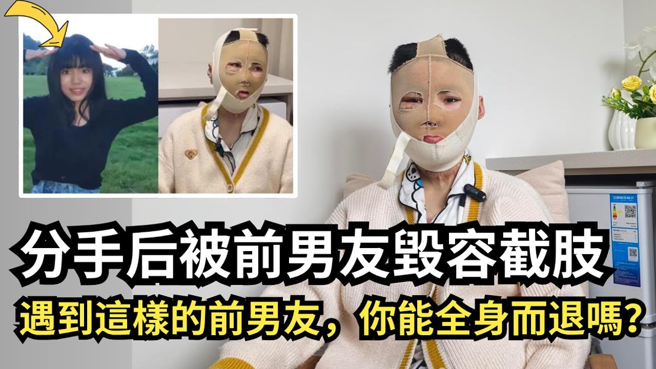 【案件】逃得掉戀愛，逃不了報復，她被潑汽油點火！毀容、截肢、判12年合理嗎？