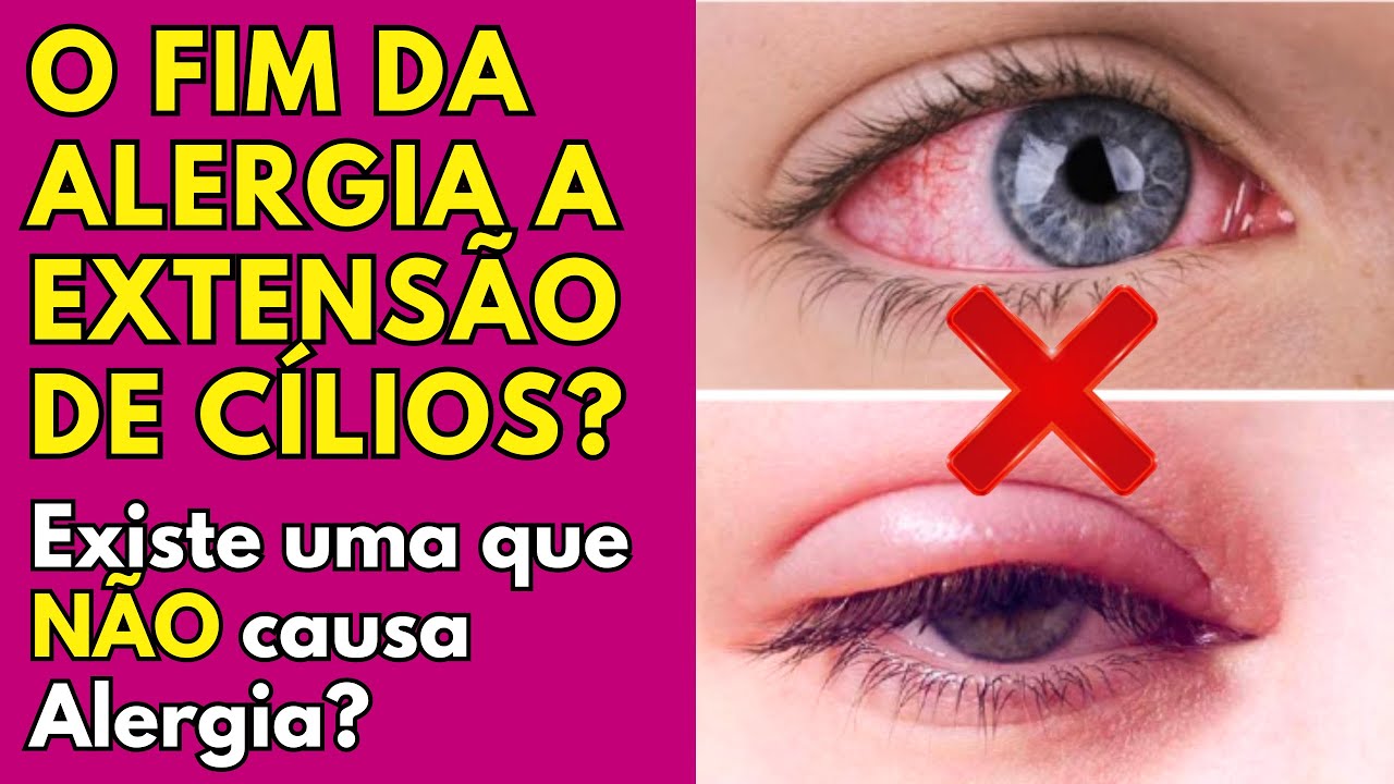 Extensão de Cílios HIPOALERGÊNICA: Existe EXTENSÃO DE CÍLIOS QUE NÃO DÁ ALERGIA?