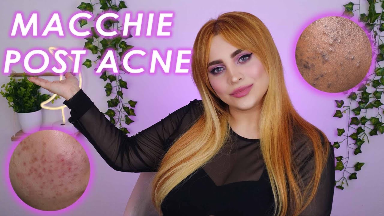 MACCHIE POST ACNE: COME ELIMINARLE!