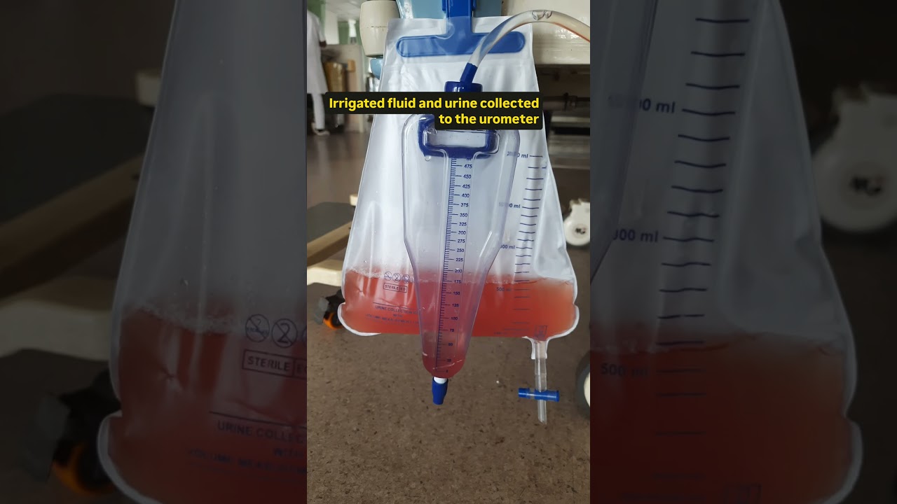 Bladder irrigation | Post TURP clot removal #anatomy #procedures #medical #hospital