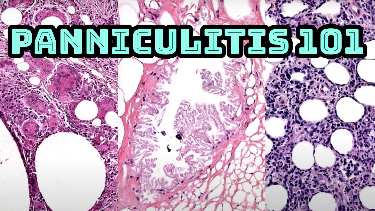 Panniculitis (Fat Inflammation & Necrosis in Subcutis) Dermpath Review pathology histology