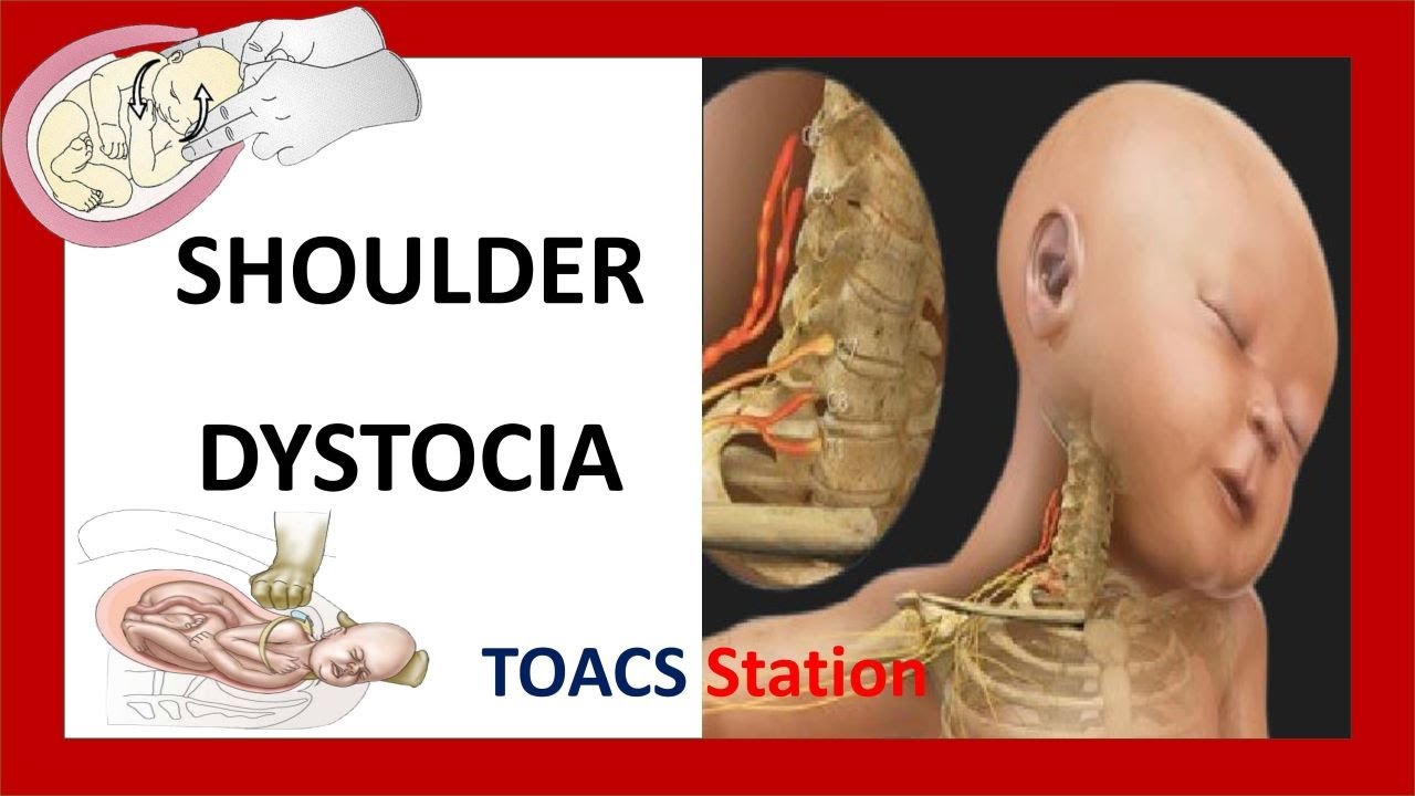 Дистоция плеч | Станция TOACS и OSCE