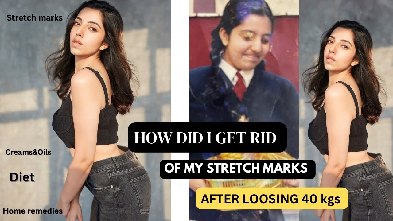 How I got rid of my Stretch Marks 🫶🏻